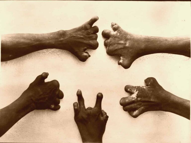 Droom over lepra | Betekenis en uitleg