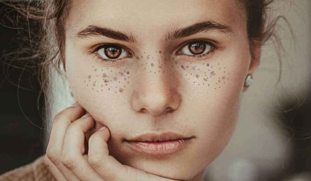 Dream freckles - dream meaning freckles