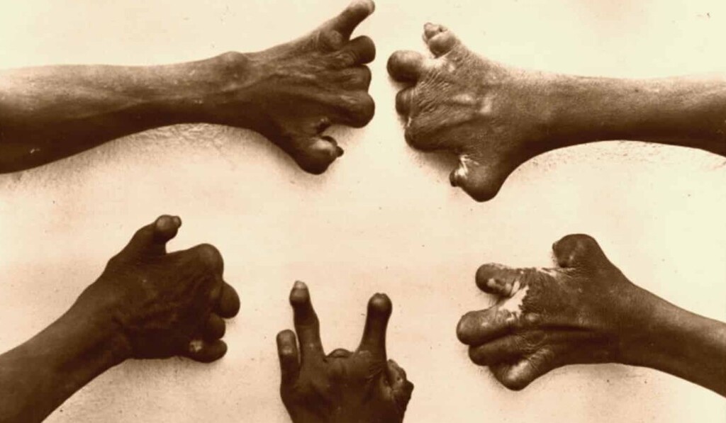 Dream leprosy - dream meaning leprosy