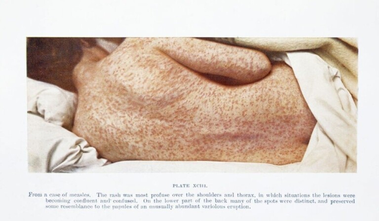 Dream measles - dream meaning measles