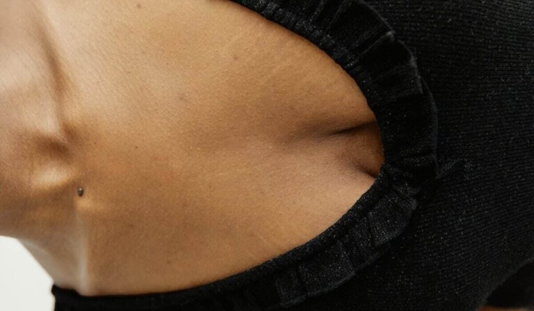 Dream stretch marks - dream meaning stretch marks