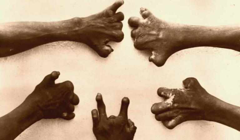 Droom lepra • droom betekenis lepra • droom uitleg op dromen.site