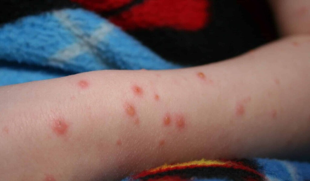 Sognare la varicella - significato dei sogni varicella