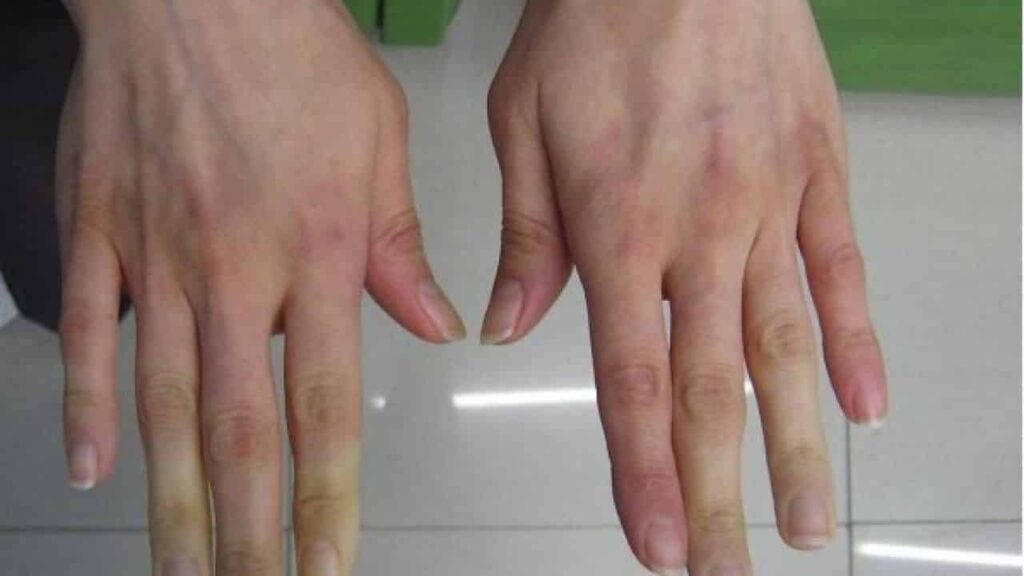 Rêver de rhumatisme | Signification et interprétation